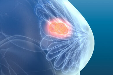 Nebenwirkungen bei Brustkrebs-Behandlung kann durch Akupunktur gelindert werden