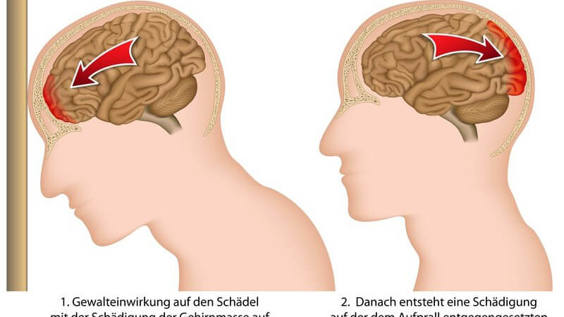 Grafik eines Schädel-Hirn-Traumas während und nach eines Kopfstoßes, mit Beschriftung