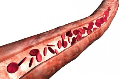 Vorsicht Venenthrombose: Blutgerinnsel in den Beinen können schwere Folgen haben