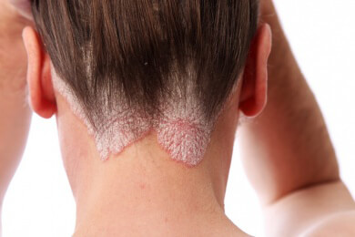 Schuppenflechte und Gelenkentzündungen: Psoriasis ist mehr als nur eine Hautkrankheit