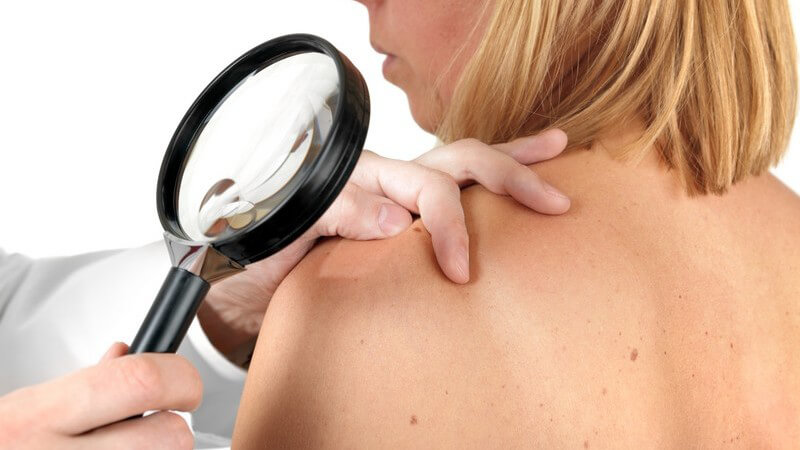 Hautarzt untersucht mit Lupe ein Muttermal auf Schulter der Patientin