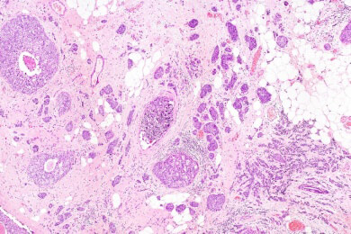 Mastektomie bei Brustkrebs: Zwei ist besser als eine