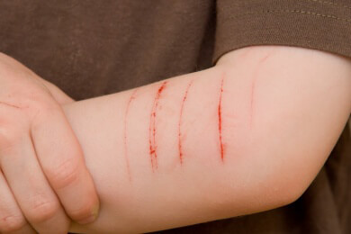 Hilfe für Borderline-Patienten: Oxytocin lindert übertriebene Sensibilität