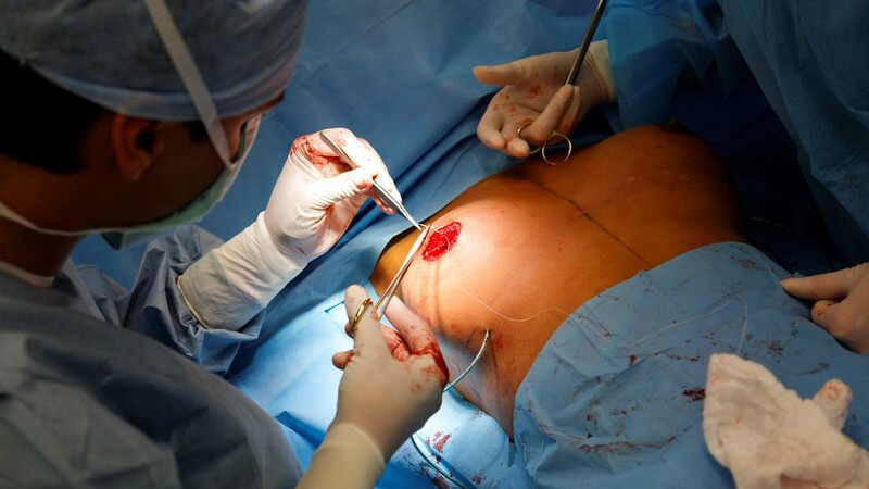 Chirurgen im Operationssaal bei Brustoperation einer Frau