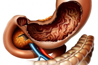 Wichtig ist was hinten rauskommt: Stuhltransplantation wieder im Kommen