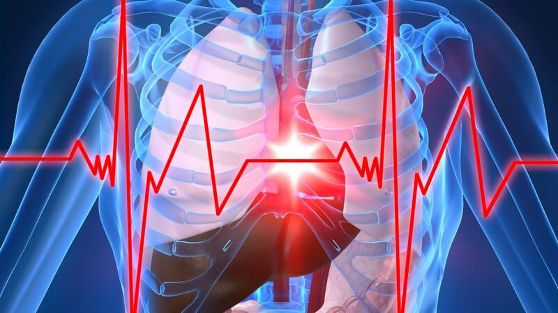 3D Grafik menschlicher Körper mit Herzinfarkt