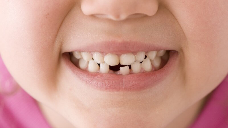 Zähne eines Kindes mit fehlendem Schneidezahn im Unterkiefer