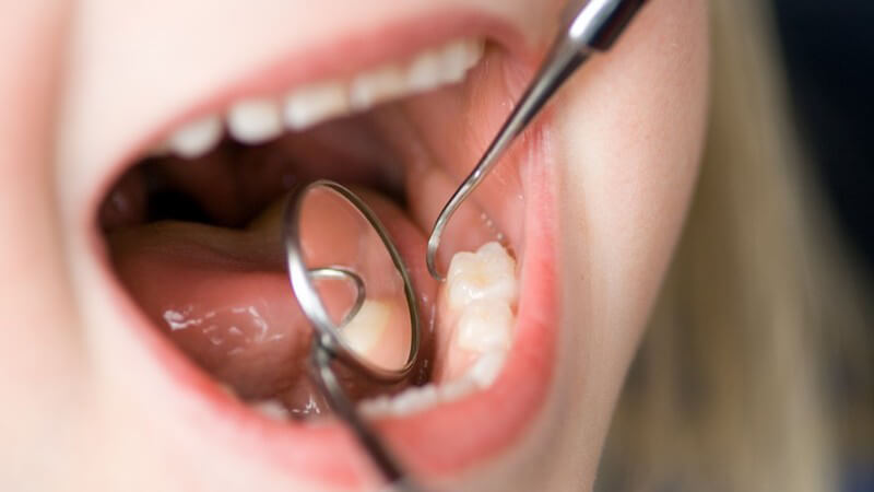 Untersuchung - Zahnarzt untersucht die Zähne eines Kindes mit Spiegel und Kratzer