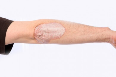 Neue Studie zeigt: Hautkrankheit Psoriasis lässt sich besser mit Biologika behandeln