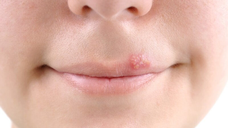 Nahaufnahme Lippen mit Herpes