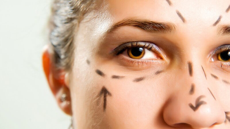 Nase, Augen und Stirn vor Schönheitsoperation mit Stift gekennzeichnet