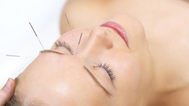 Gesicht einer jungen Frau, Akupunkturnadeln an Stirn, Auge, Wange