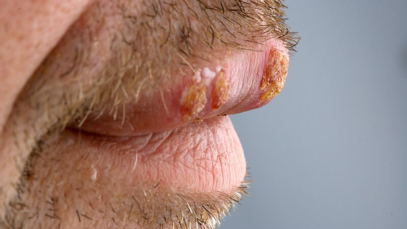 Nahaufnahme Mann mit Schnurrbart hat Herpes
