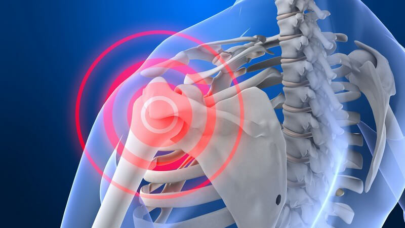 Anatomie - Grafik und Rückansicht eines durchsichtigen Oberkörpers mit schmerzender Schulter
