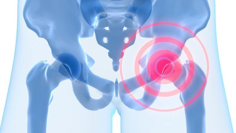 3D Grafik Hüfte Hüftschmerzen in blau und pink