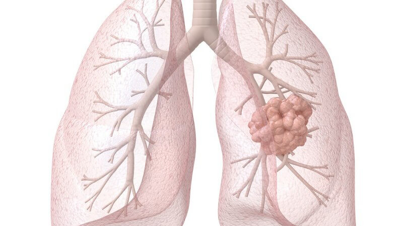 Anatomie - Grafik der Lunge mit Bronchien und Tumor