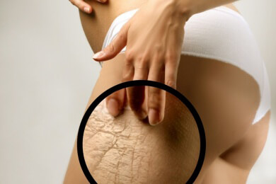 Immer wenn es Sommer wird: Frauen hadern mit Cellulite