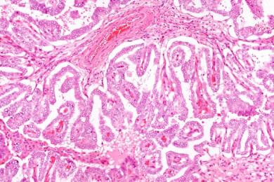 Chronische Schilddrüsenerkrankungen Hashimoto: Gefahr einer Krebserkrankung erhöht