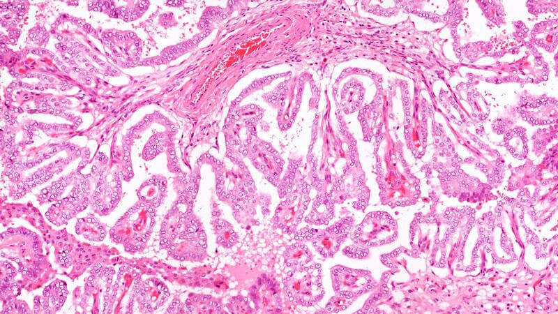 Mikroskopisches Bild Schilddrüsen-Krebs
