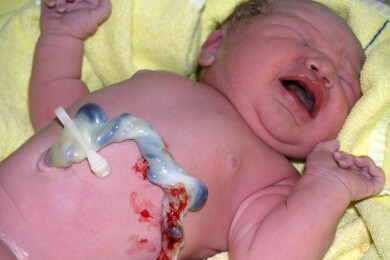 Gelbsucht bei neugeborenen Babys: Einfacher Test durch Druck auf die Stirn
