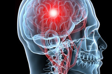 Beste Heilungschancen nach Schlaganfall durch Kombi-Therapie aus Bewegung und Medikamenten
