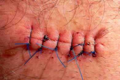 Spezielle Hautpflege kann helfen, unauffällige Narben zu erreichen