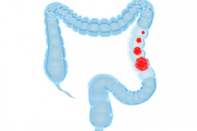Lassen Kohlenhydrate das Risiko für Darmkrebs steigen?