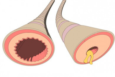 Atemnot im Alltag: Lungenpatienten sollten spezielle Ausatemtechnik lernen