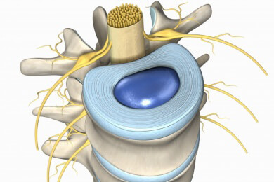 Spinale Stenose mit Steroiden therapieren: Studie sieht wenig Nutzen