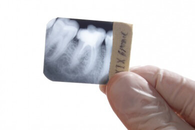 Neue Hoffnung für Blinde: Sehen mit Zahnwurzel-Implantat