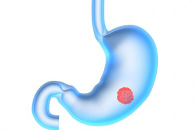 Magenkrebs bekämpfen: Botox-Injektion in den zentralen Magennerv bremst das Wachstum