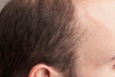 Frühwarnsystem am Kopf: Lichte Stellen im Haar weisen auf Prostatakrebs hin