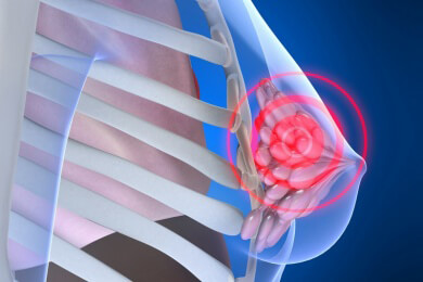 Forscher finden eine Genvariante, die vor Brustkrebs schützt