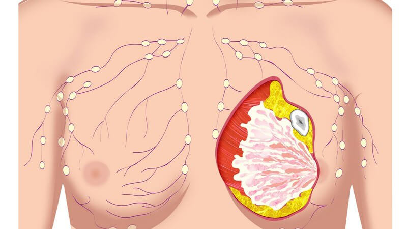 Grafische Darstellung Frauenoberkörper mit Tumor in Brust