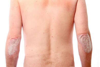Neurodermitis langfristig kontrollieren - Ärzte wollen auf eine bewährte Allergie-Therapie setzen