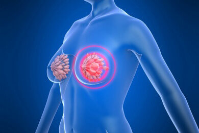 Medikamentenwechsel bei bestimmter Brustkrebsart sinnvoll: Überlebenschancen erhöht