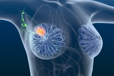 Nanoteilchen liefern den Nachweis für Lymphknotenmetastasen