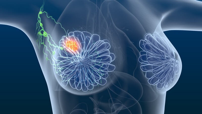3-D-Grafik einer Frau mit Brustkrebs, Tumor und Lymphknoten farblich hervorgehoben