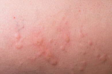 Das Östrogen ist schuld: Darum leiden Frauen unter stärkeren Allergien