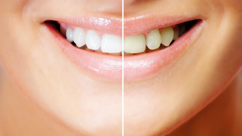 Frauenmund, zur Hälfte gelblich, zur Hälfte weißere Zähne nach Aufhellung