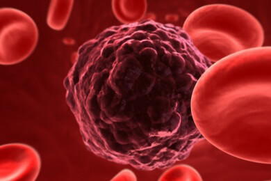 Gestörtes Immunsystem begünstigt Bildung von Lymphdrüsenkrebs