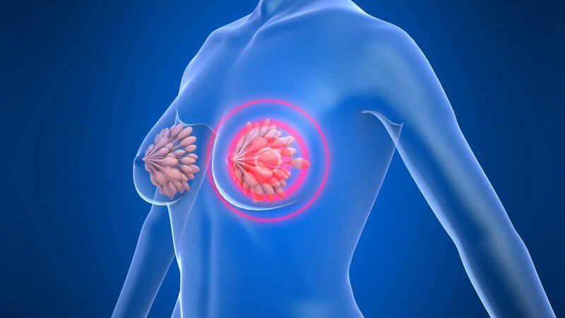 3D Grafik blauer durchsichtiger Frauenkörper, linke Brust rot gekennzeichnet, Schmerzen