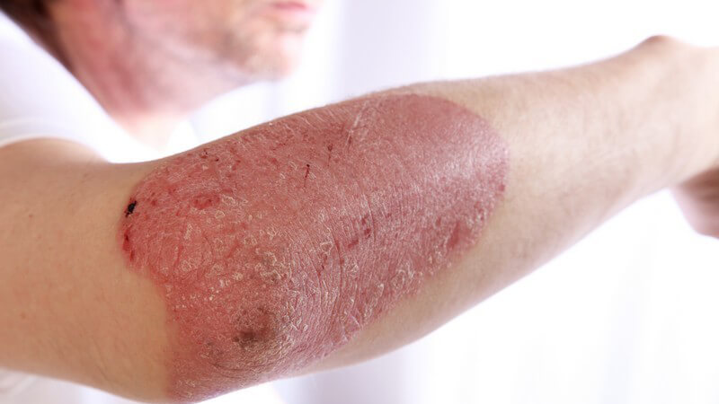 Person mit Schuppenflechte (Plaque Psoriasis) am Arm