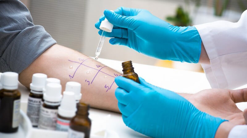 Prick-Test, Allergietest: Lösungen werden mit Pipette auf Unterarm eines Patienten geträufelt
