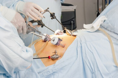 "Duodenal switch"-Bypass hilft bei extremem Übergewicht besser als der normale Magen-Bypass