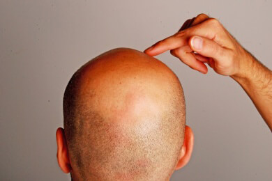 Je früher sich die Haare lichten, desto eher droht Prostatakrebs? Forscher widerlegen die Vermutung