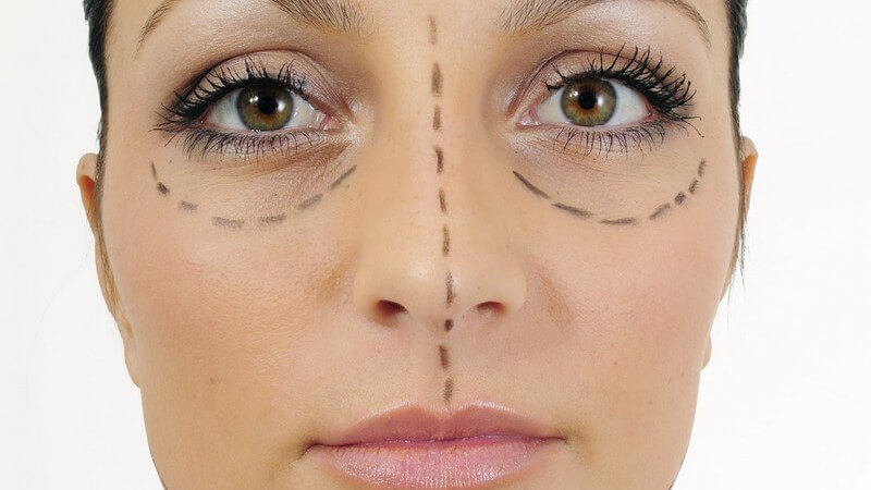 Gesicht einer Frau mit Strichen versehen vor Schönheits-OP
