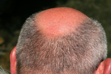 Die ersten grauen Haare: Übergewichtige ergrauen früher