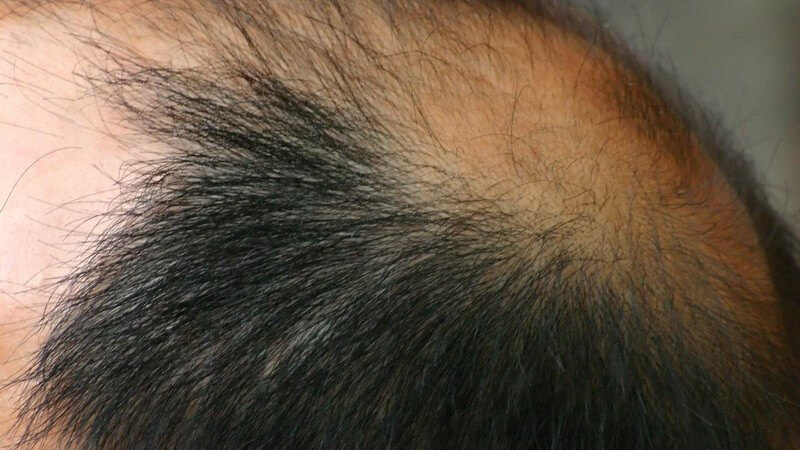 Haarausfall - Kopf eines Mannes mit schwarzen Haaren und kahlen Stellen