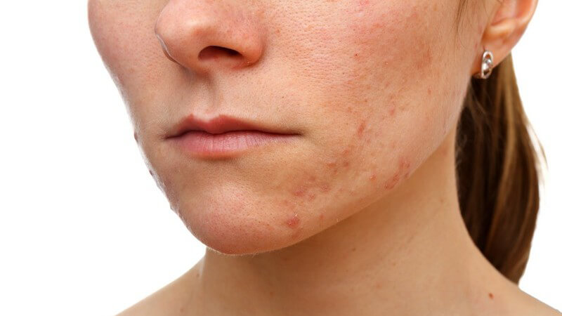 Untere Gesichtshälfte einer jungen Frau mit Hautproblemen, Rötungen und Pickeln